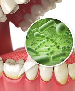 digital illustration showing closeup of bacteria beneath the gums