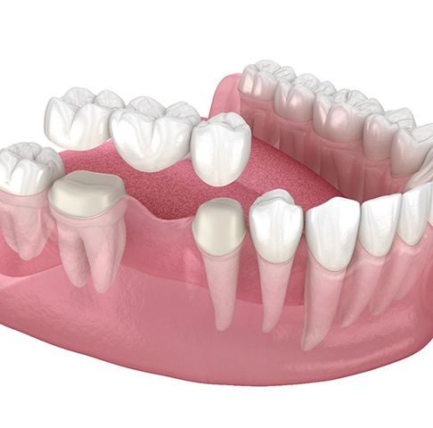Digital illustration of traditional dental bridge in Jeffersonville