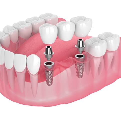 Digital illustration of implant bridge in Jeffersonville