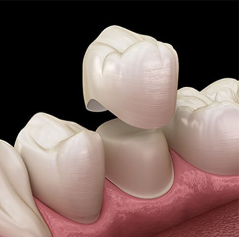 Model smile with dental crown restoration