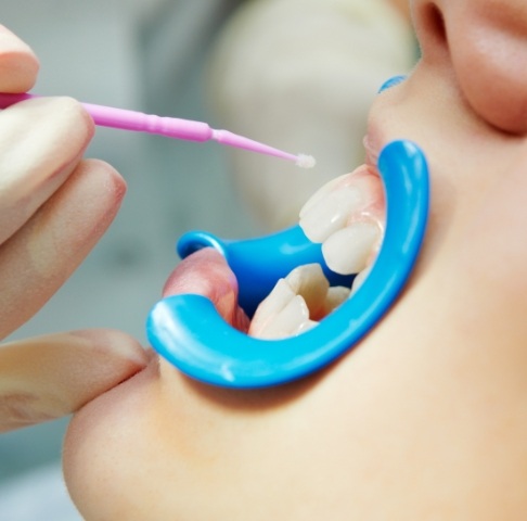 Patient receiving fluoride treatment