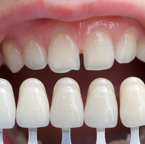 Smile compared to porcelain veneer shades during cosmetic dentistry treatment