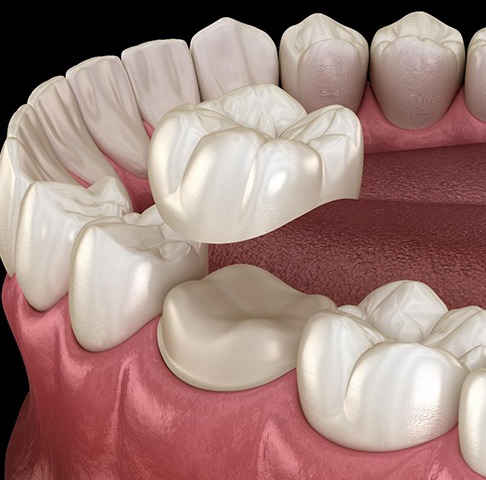 Digital illustration of a dental crown in Jeffersonville being placed
