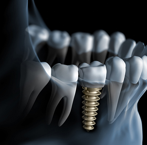 Digital illustration of an X-ray image of a dental implant within a jawbone with natural teeth