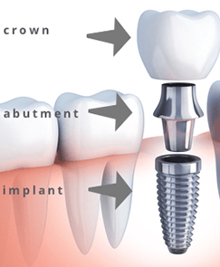 woman smiling and going through the osseointegration process