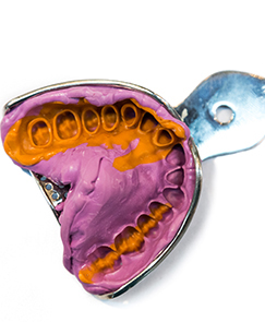 diagram of implant dentures or restorations going on implants