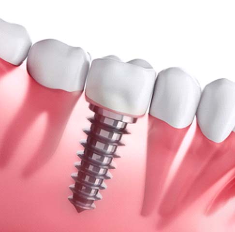 Digital illustration of dental implants in Jeffersonville