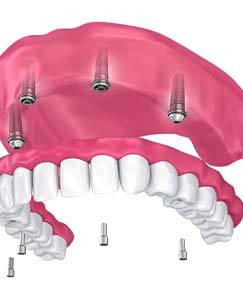 Digital illustration of implant dentures in Jeffersonville