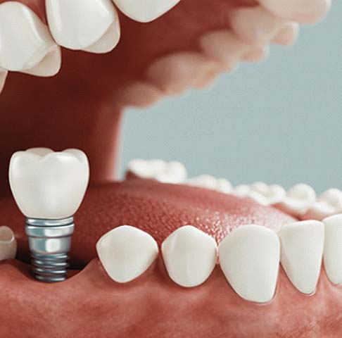 Digital illustration of a dental implant in Jeffersonville