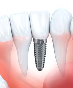 Digital diagram of a single tooth dental implant in Jeffersonville