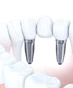 Digital illustration of an implant bridge replacing multiple missing teeth in Jeffersonville