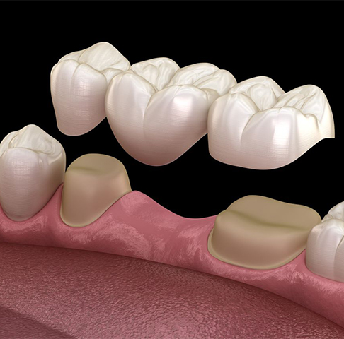 Man sharing smile after replacing missing teeth with dental bridge