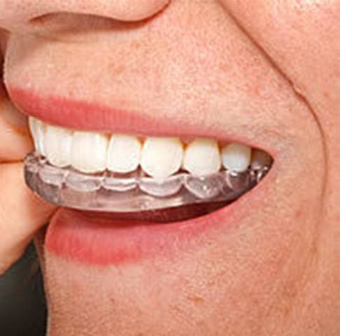 Closeup of nightguard for teeth griding in Jeffersonville