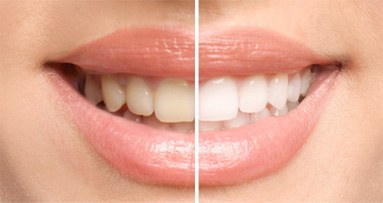 Closeup side by side of a smile before and after teeth whitening