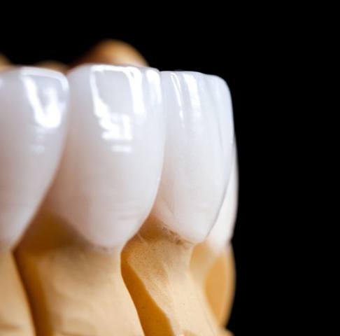 Dental model of veneers in Jeffersonville 