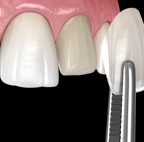 Digital illustration of getting veneers in Jeffersonville 