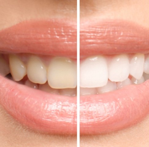 Before and after take-home teeth whitening kit in Jeffersonville 
