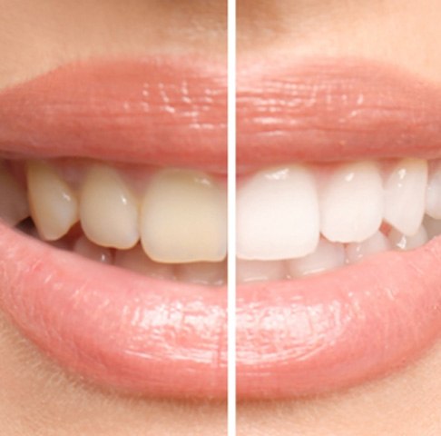 Before and after take-home teeth whitening kit in Jeffersonville