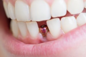 Closeup of patient's smile after getting dental implants in Jeffersonville