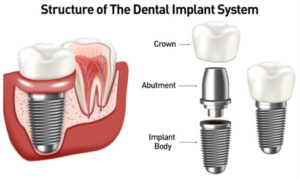 Digital illustration of the structure of the dental implant system